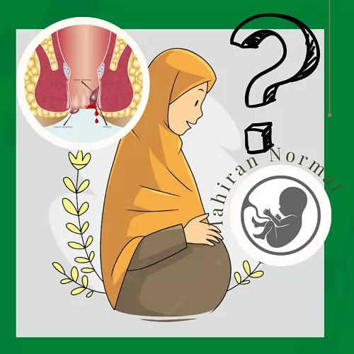 resiko ambeien saat hamil dan melahirkan